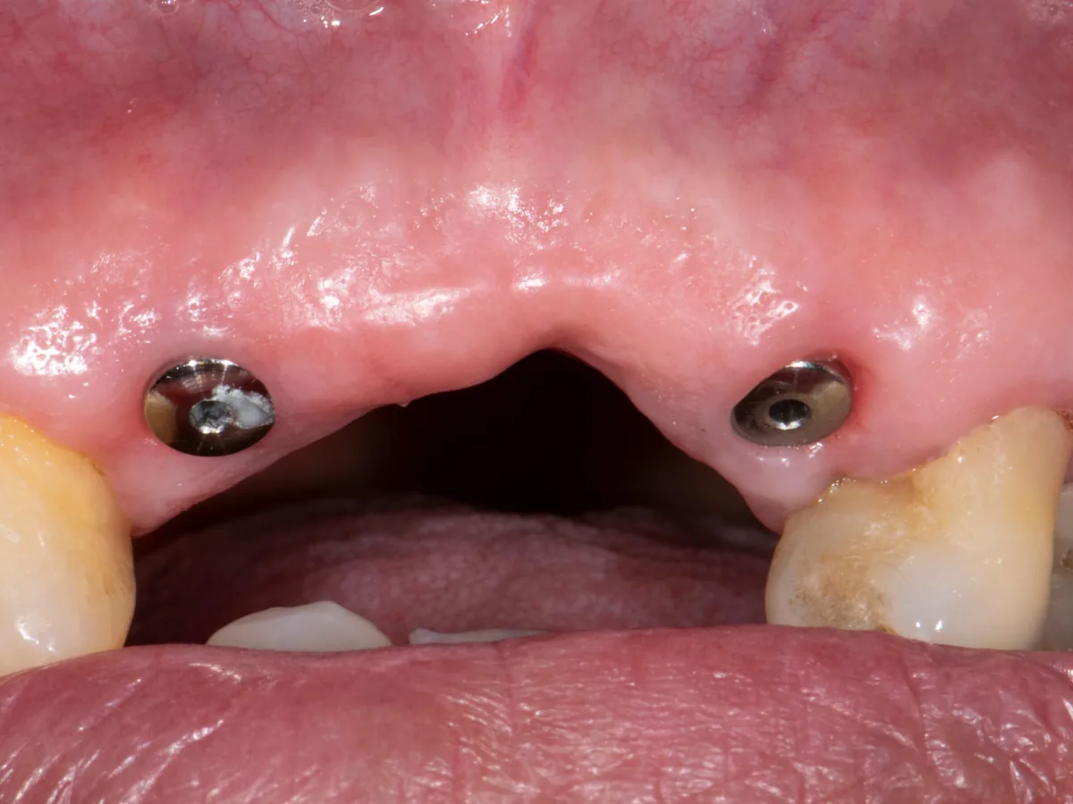 Implantes colocados en el maxilar superior en fase de cicatrización