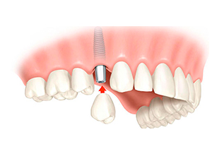 Implante dental de un diente